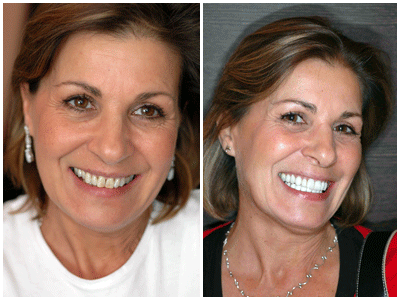 Before After Pictures Of Veneers 91
