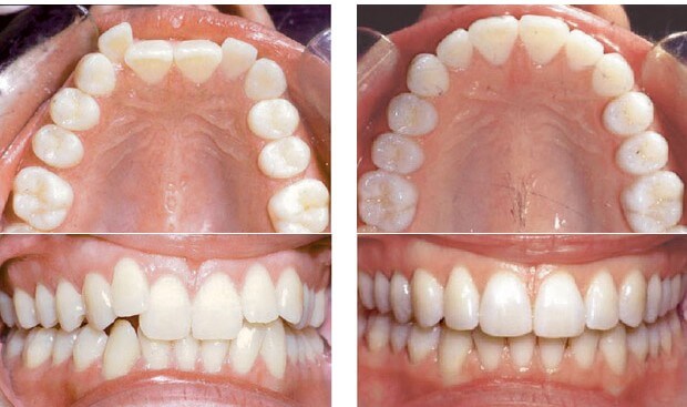 invisalign before after1 e1342063593771