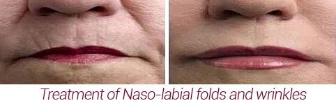 nasolabial folds