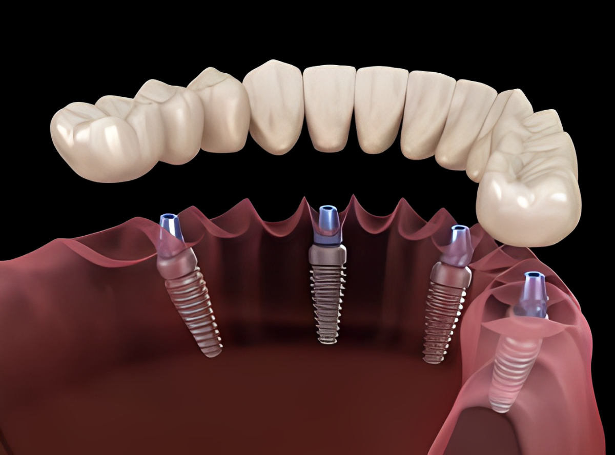 All-on-4 Dental implants